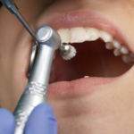 <strong>What are the benefits of Deep Teeth Cleaning?</strong>